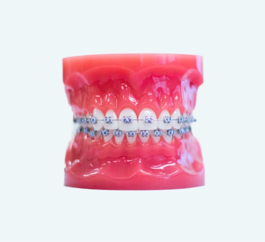 metal braces on plastic model