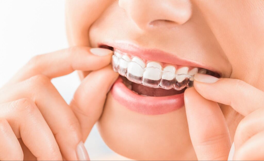 Get the Most Out of Your Invisalign Treatment
